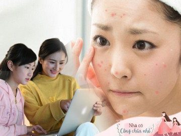 Cùng con đối phó với mụn dậy thì, mẹ đừng bỏ qua loạt lời khuyên của chuyên gia