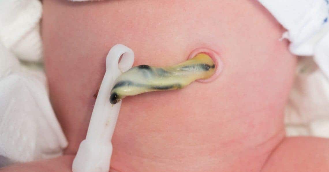 Hình ảnh rốn trẻ sơ sinh bị nhiễm trùng khiến nhiều mẹ sửng sốt  - 4