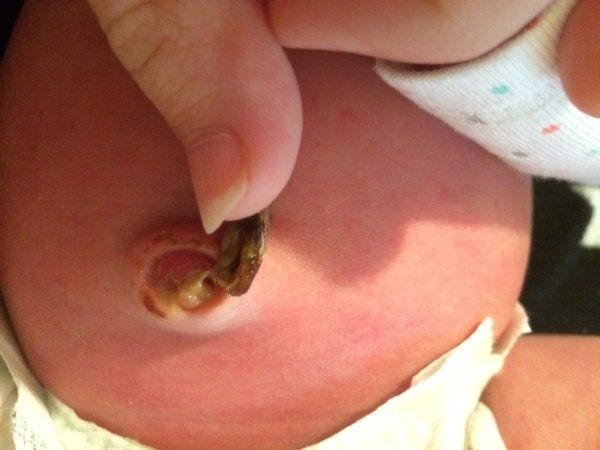 Hình ảnh rốn trẻ sơ sinh bị nhiễm trùng khiến nhiều mẹ sửng sốt  - 3