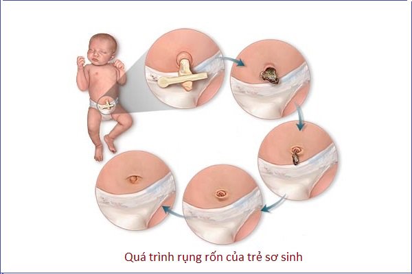 Hình ảnh rốn trẻ sơ sinh bị nhiễm trùng khiến nhiều mẹ sửng sốt  - 6