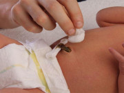 Làm mẹ - Rốn trẻ sơ sinh bị chảy máu phải làm sao?