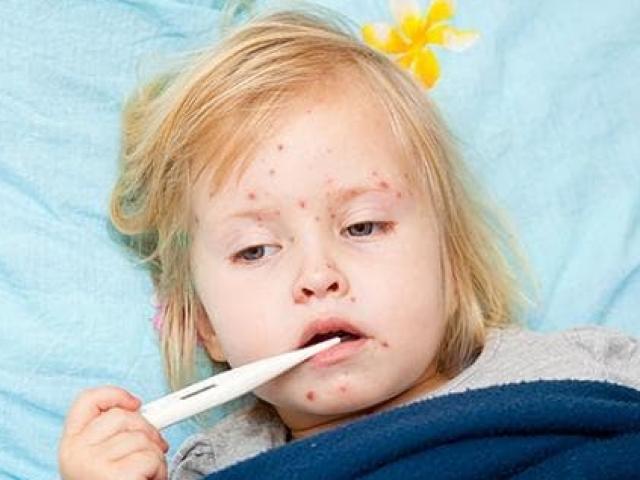 Bệnh thủy đậu có lây không và các cách phòng bệnh cho trẻ