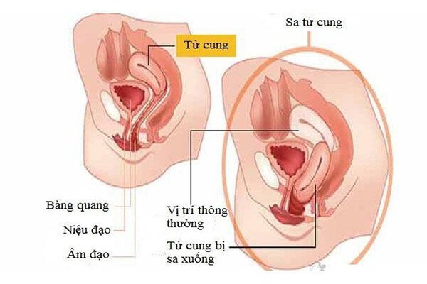 Sa tử cung độ 2