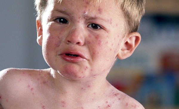 Các triệu chứng sốt phát ban ở trẻ xuất hiện sớm - 3