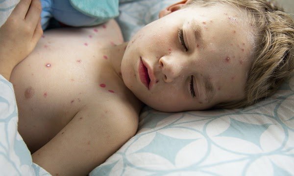 Bệnh thủy đậu ở trẻ em nên kiêng gì và cách điều trị tại nhà nhanh khỏi - 2