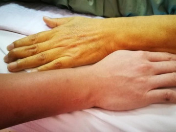 Bệnh xơ gan nguyên nhân do đâu các triệu chứng phát hiện sớm