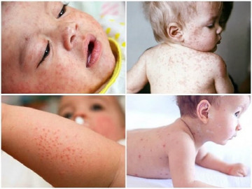 Dấu hiệu bệnh sởi ở trẻ dễ nhận biết và các cách điều trị hiệu quả