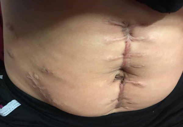9x yen bai khoe vet mo de nhu con ret giua bung, nhin anh thoi son tre ma xot xa - 1