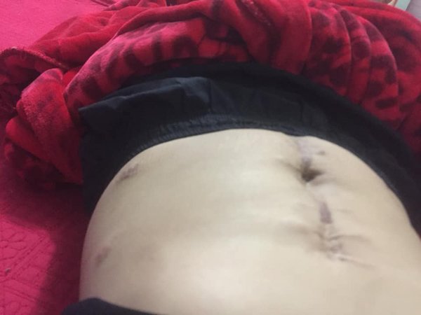 9x yen bai khoe vet mo de nhu con ret giua bung, nhin anh thoi son tre ma xot xa - 7