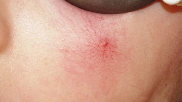 Trên cơ thể có nốt ruồi này, cẩn thận gan đã hỏng, khám sớm kẻo chữa không kịp - 2
