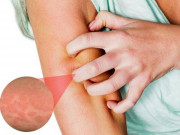 Sức khỏe - Mùa đông ngứa ngáy cào xước da, dễ nhiễm khuẩn: Chuyên gia chỉ 6 cách đơn giản để hết ngứa