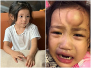 Làm mẹ - Con gái Hải Băng bị cào rách mặt vì ẩu đả, con Ốc Thanh Vân tai nạn còn xót hơn