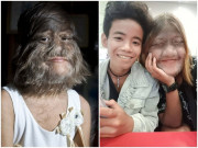 Sức khỏe - Cô bé nhiều lông nhất TG do mắc bệnh, sau 10 năm lần đầu khoe mặt thật bên bạn trai