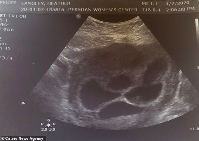 Cặp đồng tính nữ đi amp;#34;xin giốngamp;#34; sinh con, lần đầu đi siêu âm bác sĩ báo có 5 thai - 3