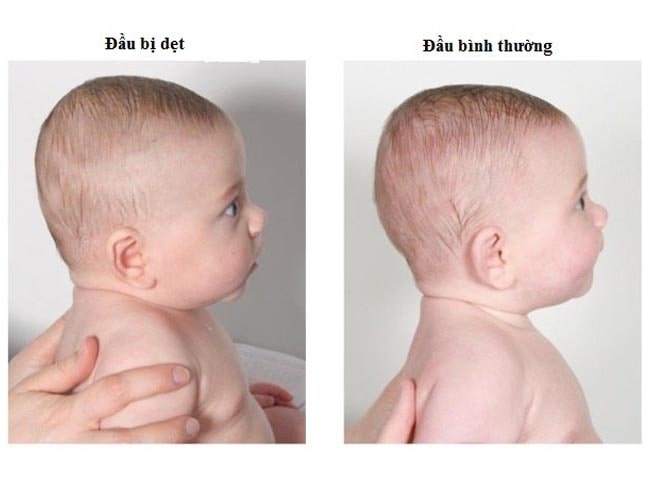 Hội chứng đầu phẳng ở trẻ sơ sinh: 3 việc mẹ cần làm sớm để tránh hậu họa - 4
