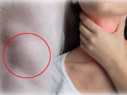 Sức khỏe - 4 dấu hiệu sớm của bệnh ung thư thanh quản nhưng nhiều người dễ tưởng bệnh vặt