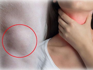 4 dấu hiệu sớm của bệnh ung thư thanh quản nhưng nhiều người dễ tưởng bệnh vặt