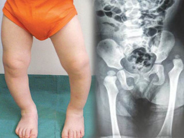 4 bước đơn giản mẹ có thể kiểm tra xem bé sơ sinh có mắc loạn sản khớp háng