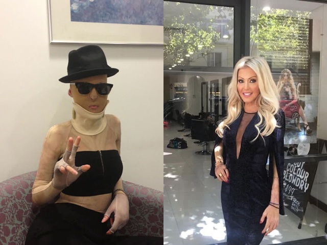 Người phụ nữ bị đánh ghen, tạt axit đến mức hủy hoại dung nhan 9 năm trước giờ ra sao?