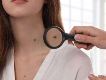 Loại nốt ruồi nào có nguy cơ ung thư? Đừng chủ quan nếu thấy nốt ruồi có đặc điểm này