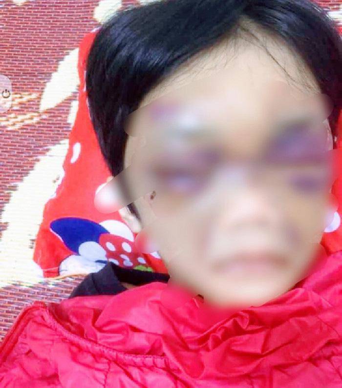Mẹ đẻ bạo hành con gái 6 tuổi thâm tím mặt mày, nhốt trong phòng trọ - 1