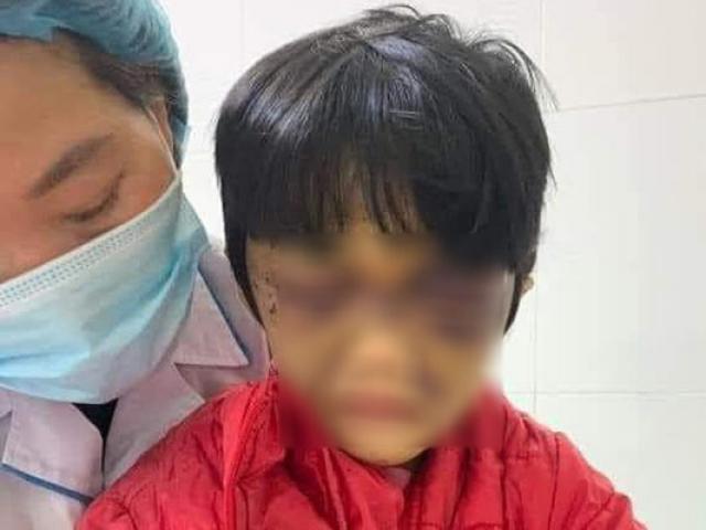 Mẹ đẻ bạo hành con gái 6 tuổi thâm tím mặt mày, nhốt trong phòng trọ