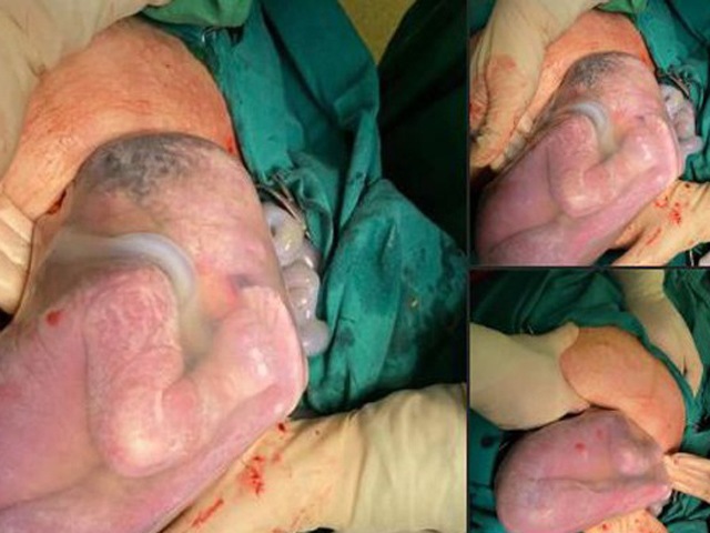 Mẹ 9X Phú Thọ sinh đôi, một bé còn nằm trong bọc ối gặm chân ngon lành