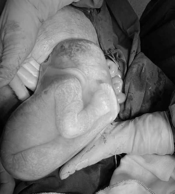 Mẹ 9X Phú Thọ sinh đôi, một bé còn nằm trong bọc ối amp;#34;gặm chân ngon lànhamp;#34; - 1