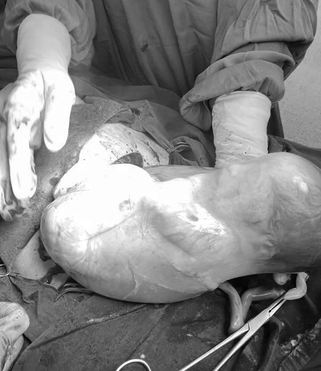 Bất ngờ hình ảnh một em bé song sinh chào đời vẫn còn nguyên trong bọc ối - 2