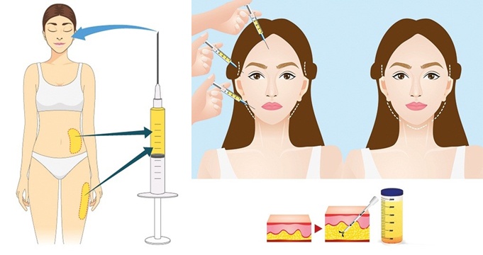 Hoa hậu Indonesia hỏng mặt vì phẫu thuật thẩm mỹ, chuyên gia nói gì về trường hợp này? - 4