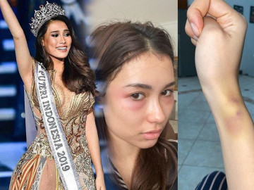 Hoa hậu Indonesia hỏng mặt vì phẫu thuật thẩm mỹ, chuyên gia nói gì về trường hợp này?
