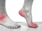 Sức khỏe - Bệnh gout nên ăn gì? Thực phẩm tốt cho người bệnh gout