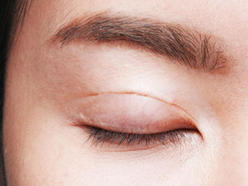 Cô gái gặp biến chứng mù mắt, nguy kịch tới tính mạng sau khi cắt mí ở spa