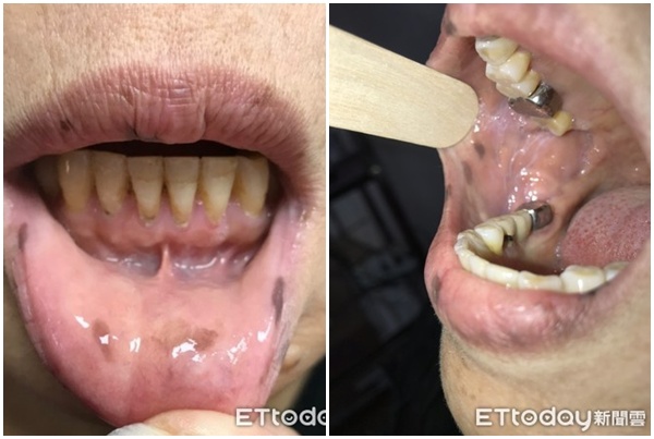 Hãy cẩn thận với những đốm đen trên tay, miệng, cảnh báo nguy cơ ung thư cao - 2