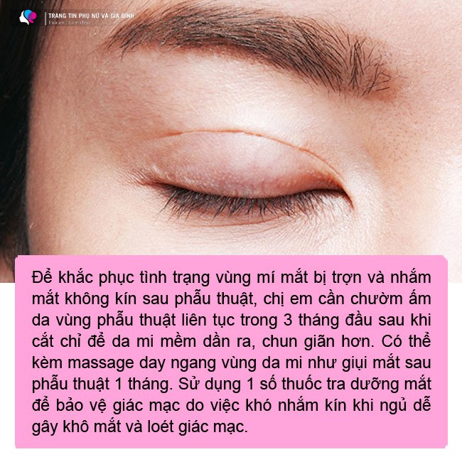 Đi cắt mí chơi Tết, cô nàng nhận về cái kết không đóng nổi mắt, chị em cảnh tỉnh - 7