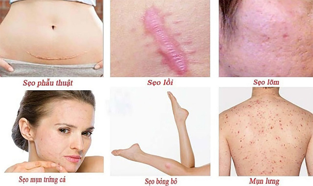 Actiscar – “cứu tinh” của những làn da bị sẹo - 1