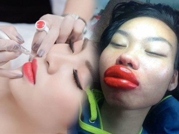 Đi phun môi ăn Tết, gái xinh số nhọ nhận về cái kết môi sưng như quả chuối mắn