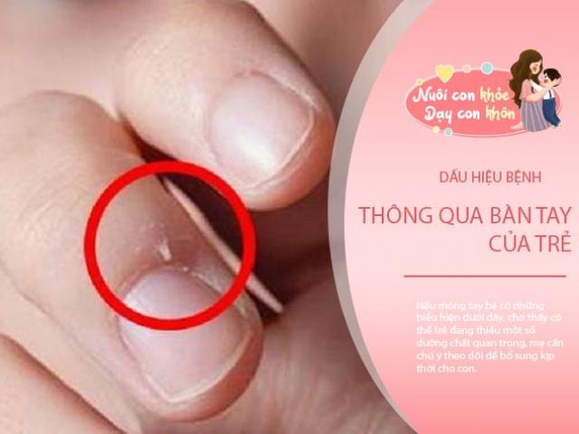 Trẻ bị xước móng tay là dấu hiệu bệnh gì? BS Nhi, có thể bé thiếu chất này