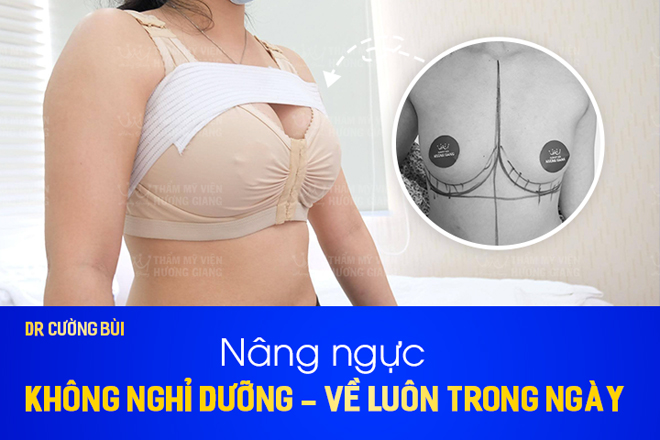 Nâng ngực nội soi khe khít cùng Bác sĩ thẩm mỹ Cường Bùi - 2