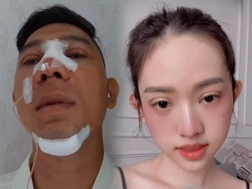 Những chiếc mí mắt sưng phù hậu dao kéo làm sao Việt hoang mang