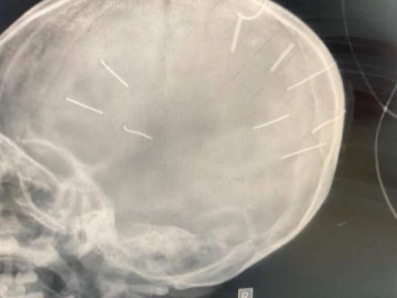 Sức khoẻ bé gái 3 tuổi bị đóng đinh vào đầu giờ ra sao?