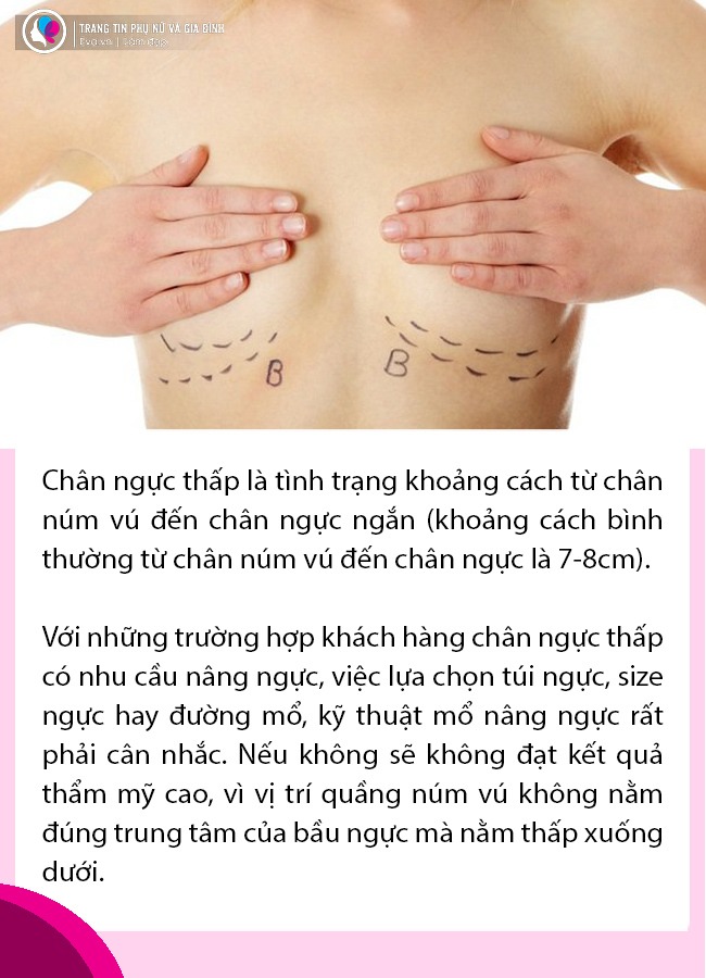 Nâng ngực: 5 câu hỏi bạn cần phải biết về tình trạng amp;#34;núi đôiamp;#34; của mình trước khi trùng tu - 3