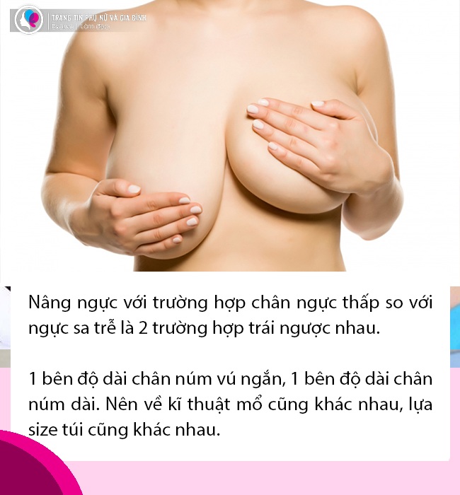 Nâng ngực: 5 câu hỏi bạn cần phải biết về tình trạng amp;#34;núi đôiamp;#34; của mình trước khi trùng tu - 4