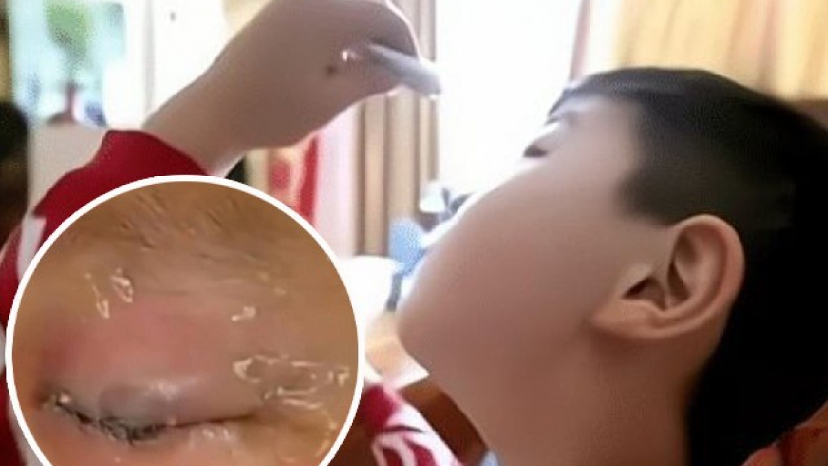 Con nhỏ keo 502 vào mắt, mẹ không đến bệnh viện mà xịt thêm 1 thứ, bác sĩ khen ngợi