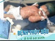 Sức khỏe - Bố mẹ chủ quan, bé 15 ngày tuổi nguy kịch do mắc thủy đậu, BS cảnh báo sai lầm này