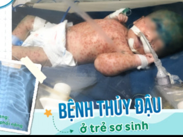 Bố mẹ chủ quan, bé 15 ngày tuổi nguy kịch do mắc thủy đậu, BS cảnh báo sai lầm này