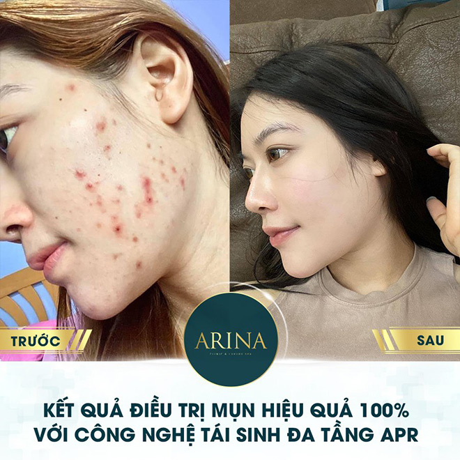 Phái đẹp hào hứng trước dịch vụ trị mụn Tái sinh đa tầng APR tại Viện thẩm mỹ Arina - 3