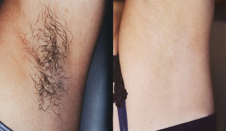 Armpit hair removal, a life-saving cosmetic procedure for women on a hot summer day - 1