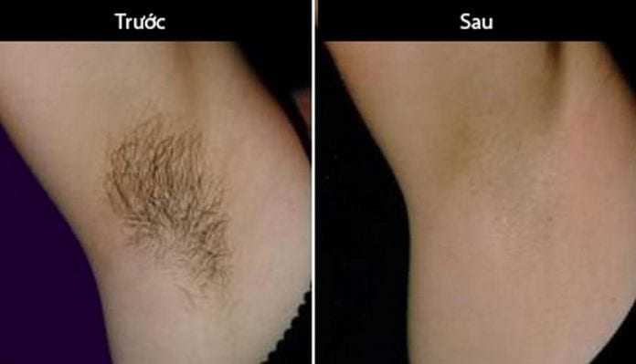 Armpit hair removal, a life-saving cosmetic procedure for women on a hot summer day - 7