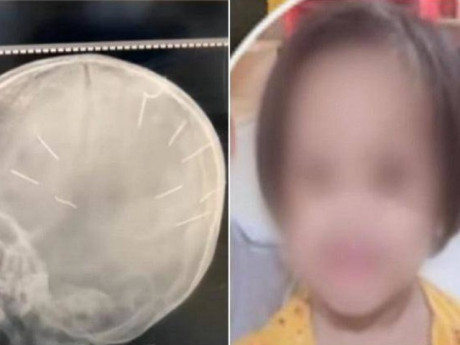 Bé gái 3 tuổi bị người tình của mẹ đóng đinh vào đầu đã tử vong: Nghi phạm có thể đối diện mức án "Tử hình"